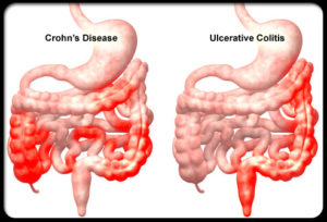 crohns-disease-s5-illustration-of-crohns-disease-and-ulcerative-colitis